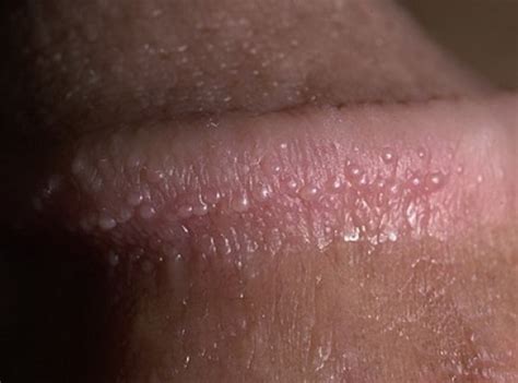 couronne perlée|Traitement des papules perlées du gland